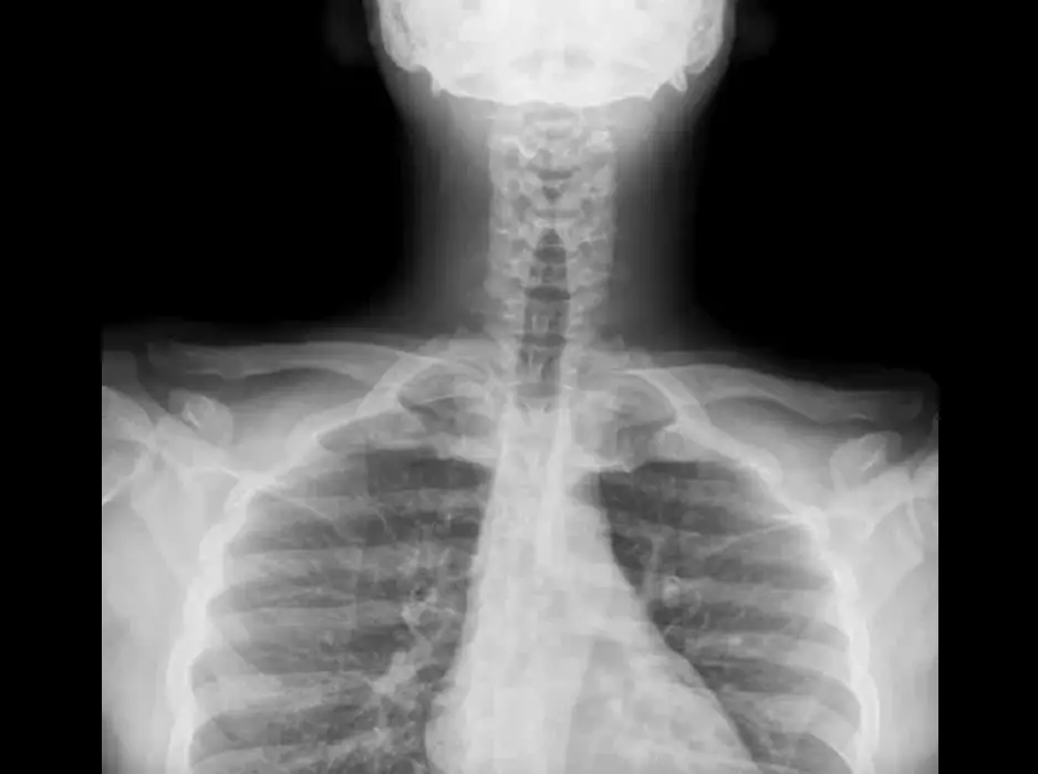 X-ray stitching
