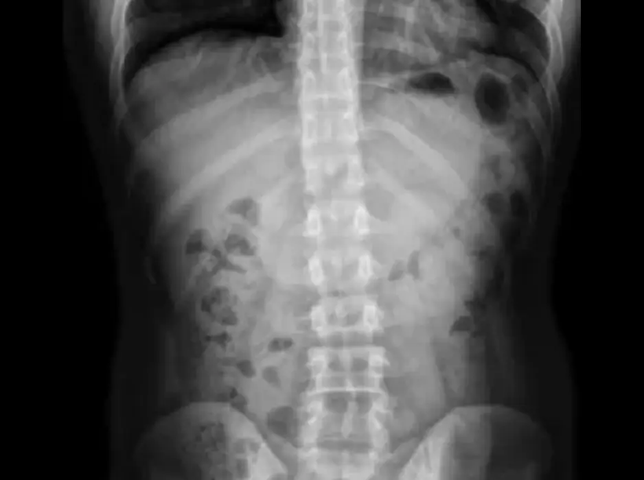 X-ray stitching
