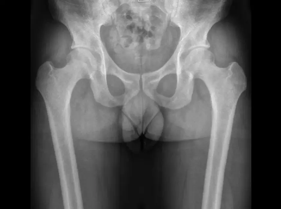 X-ray stitching