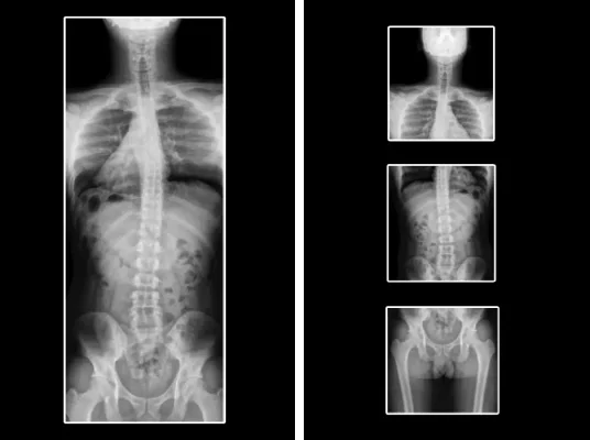 X-ray image stitching for full spine image