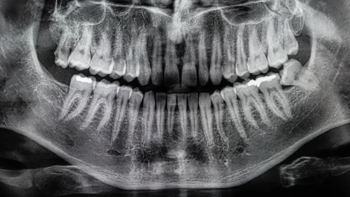 CBCT OPG Equipment